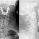 X-ray images of the dentures.